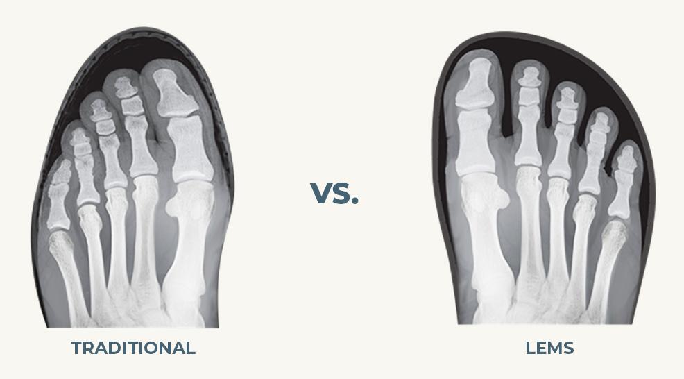 Bone structure in feet. Compares traditional shoes with squished bones.